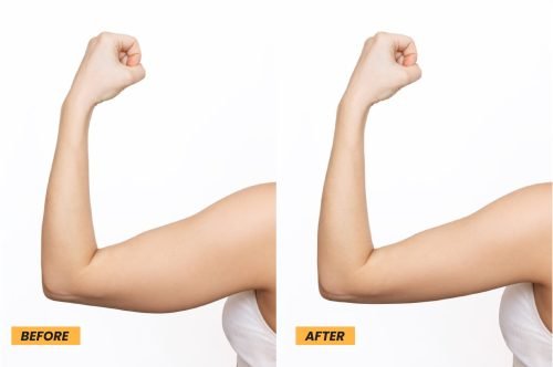 coolsculpting